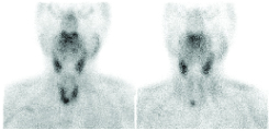 thyroid scan